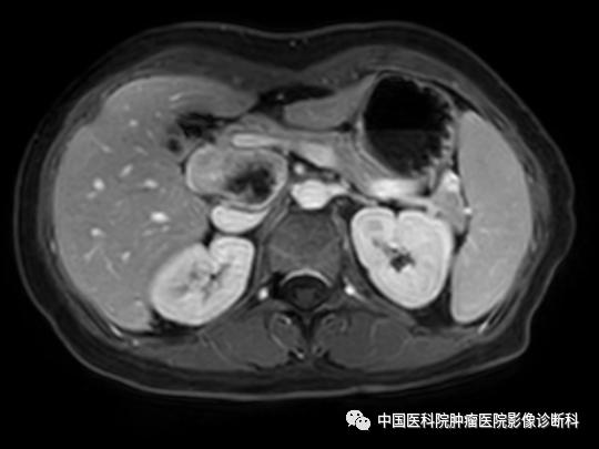 影像PPT - 【病例】胰腺神经内分泌肿瘤1例CT及MR影像-11 影像PPT - 【病例】胰腺神经内分泌肿瘤1例CT及MR影像-11