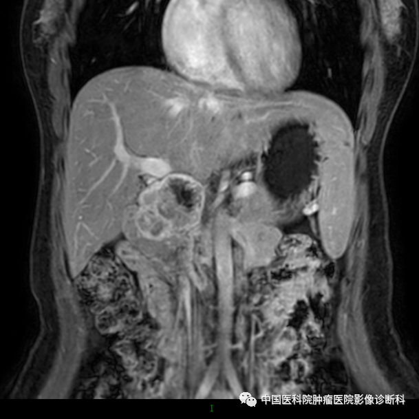 影像PPT - 【病例】胰腺神经内分泌肿瘤1例CT及MR影像-13 影像PPT - 【病例】胰腺神经内分泌肿瘤1例CT及MR影像-13