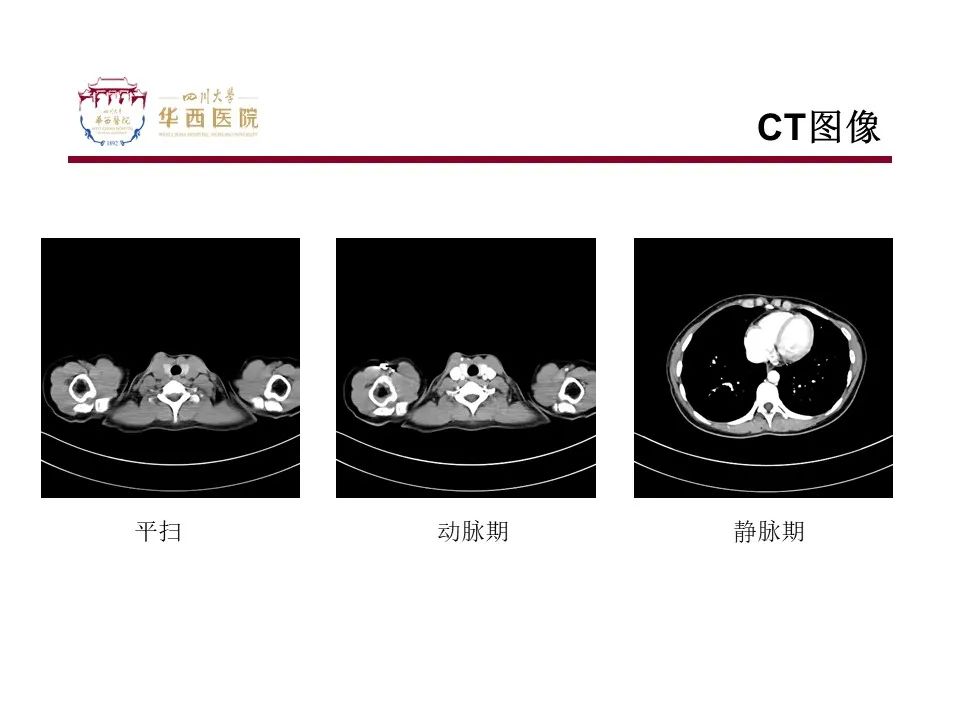 影像PPT - 【病例】TFE3重排肾细胞癌1例CT影像-3