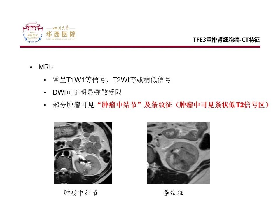 影像PPT - 【病例】TFE3重排肾细胞癌1例CT影像-9