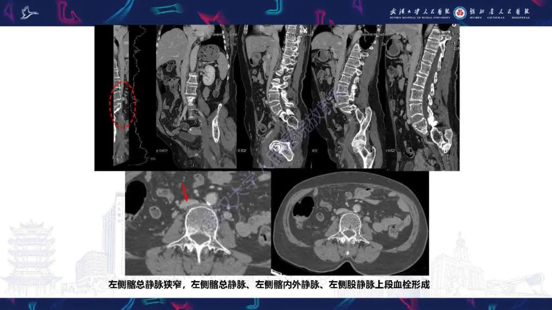 影像PPT - 【PPT】髂静脉压迫综合征影像诊断-6