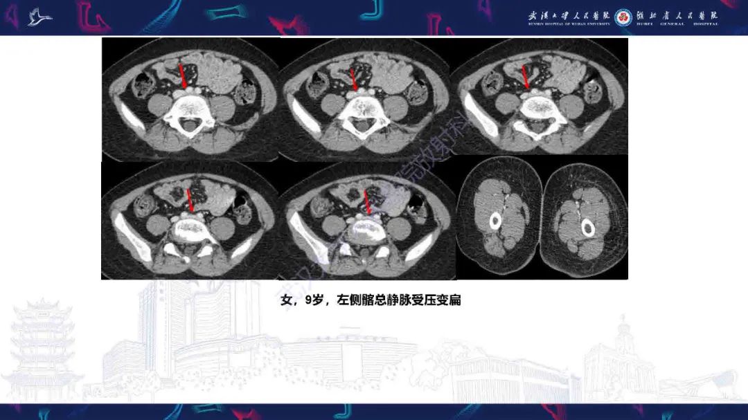 影像PPT - 【PPT】髂静脉压迫综合征影像诊断-8