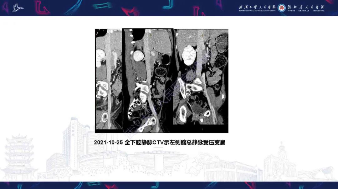 影像PPT - 【PPT】髂静脉压迫综合征影像诊断-9