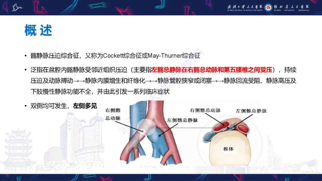 影像PPT - 【PPT】髂静脉压迫综合征影像诊断-11