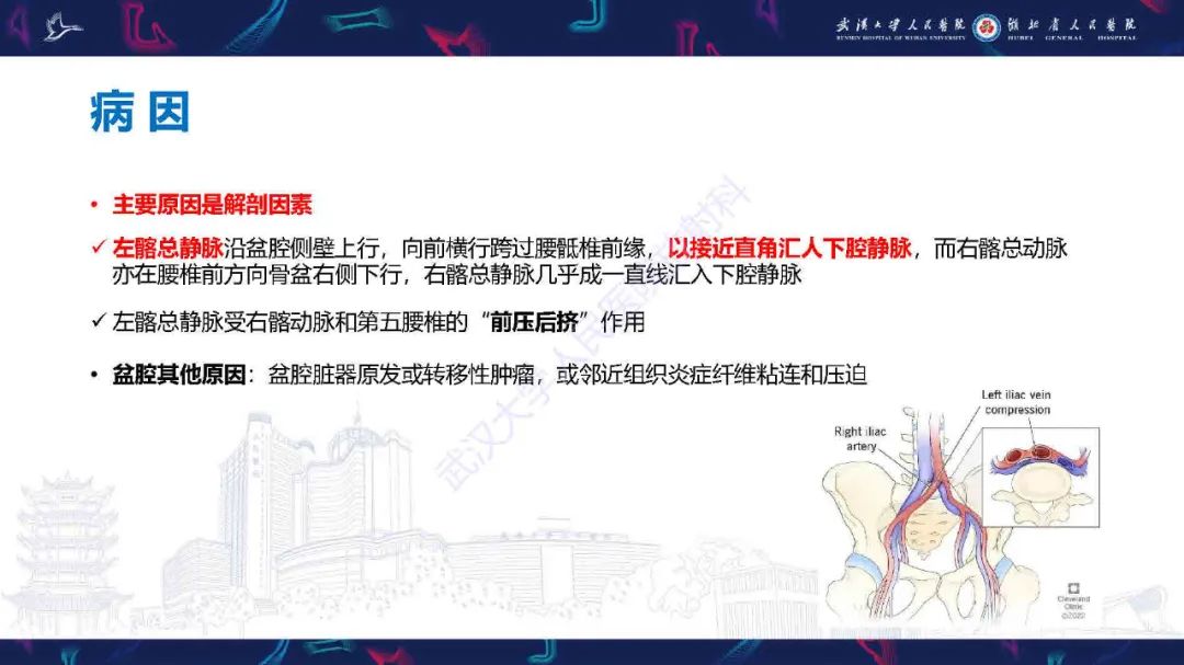 影像PPT - 【PPT】髂静脉压迫综合征影像诊断-13
