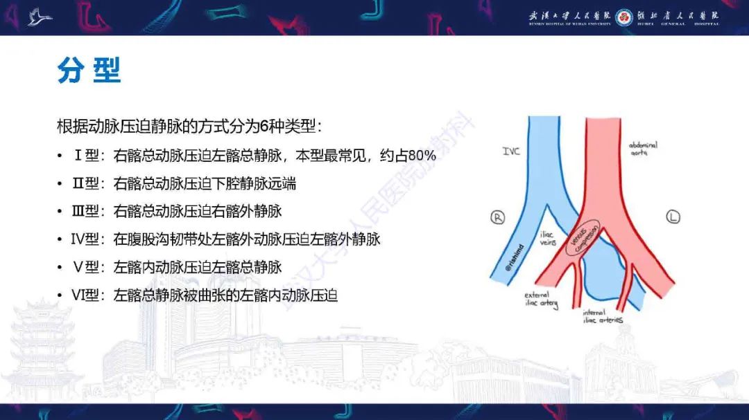 影像PPT - 【PPT】髂静脉压迫综合征影像诊断-14