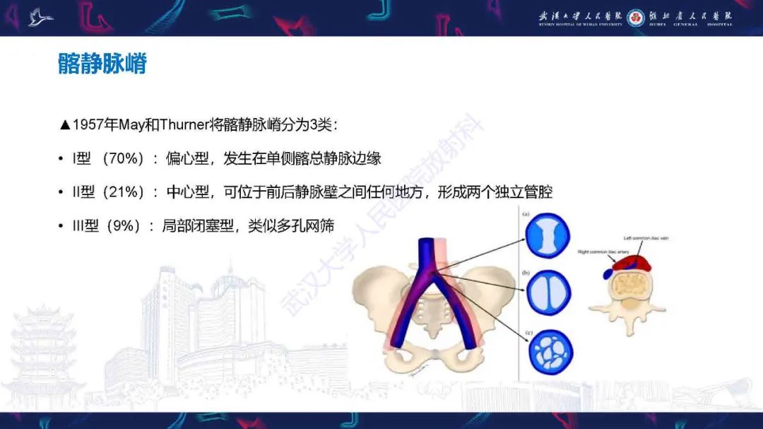 影像PPT - 【PPT】髂静脉压迫综合征影像诊断-16