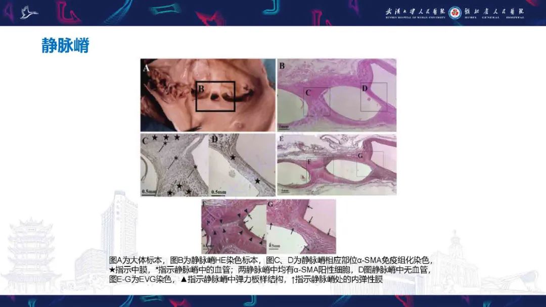 影像PPT - 【PPT】髂静脉压迫综合征影像诊断-17
