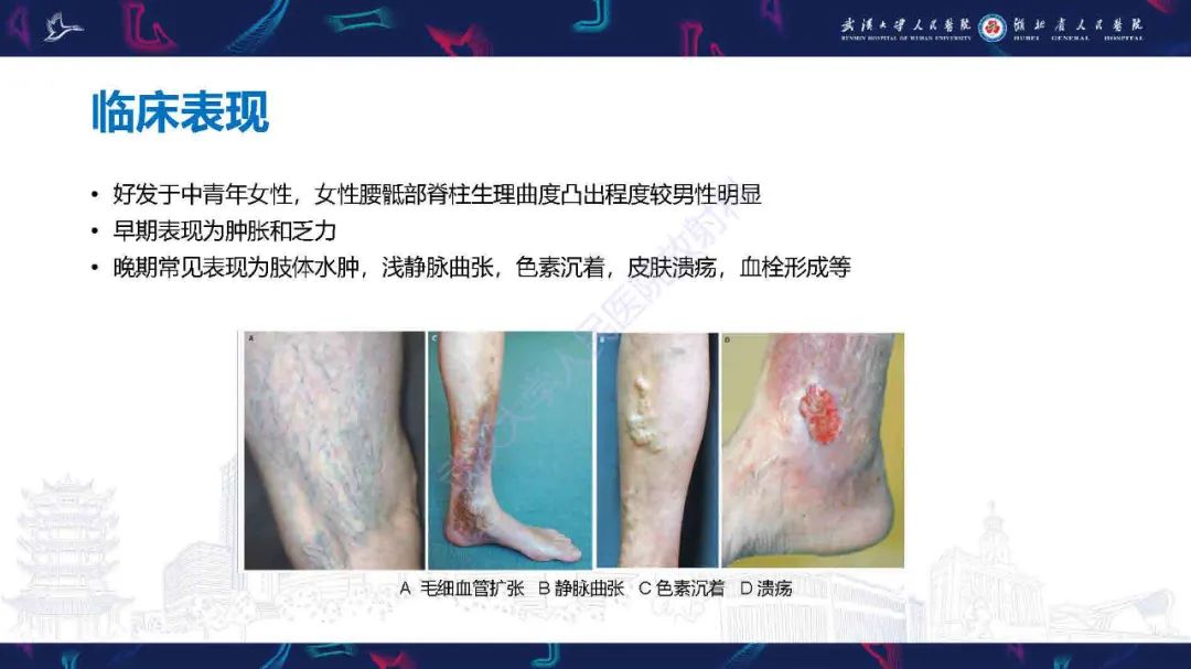 影像PPT - 【PPT】髂静脉压迫综合征影像诊断-20