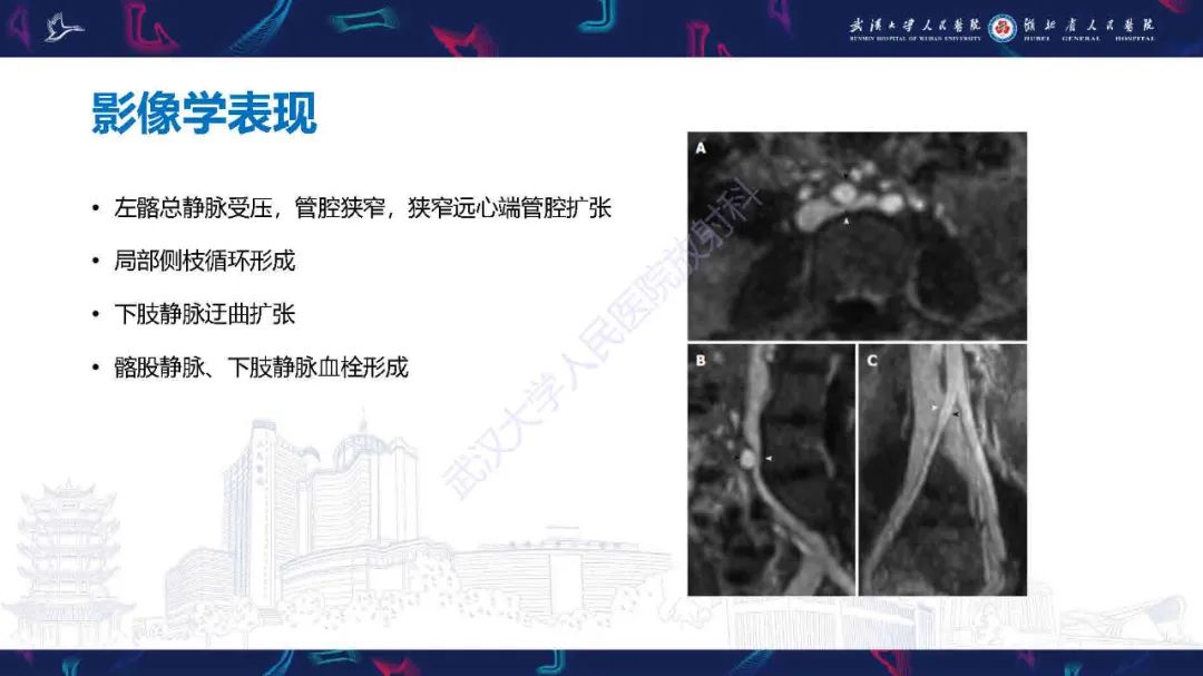 影像PPT - 【PPT】髂静脉压迫综合征影像诊断-25