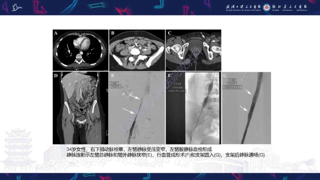 影像PPT - 【PPT】髂静脉压迫综合征影像诊断-26