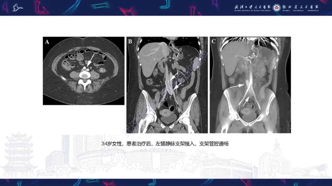影像PPT - 【PPT】髂静脉压迫综合征影像诊断-27