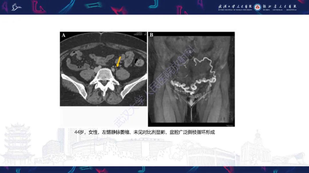 影像PPT - 【PPT】髂静脉压迫综合征影像诊断-28