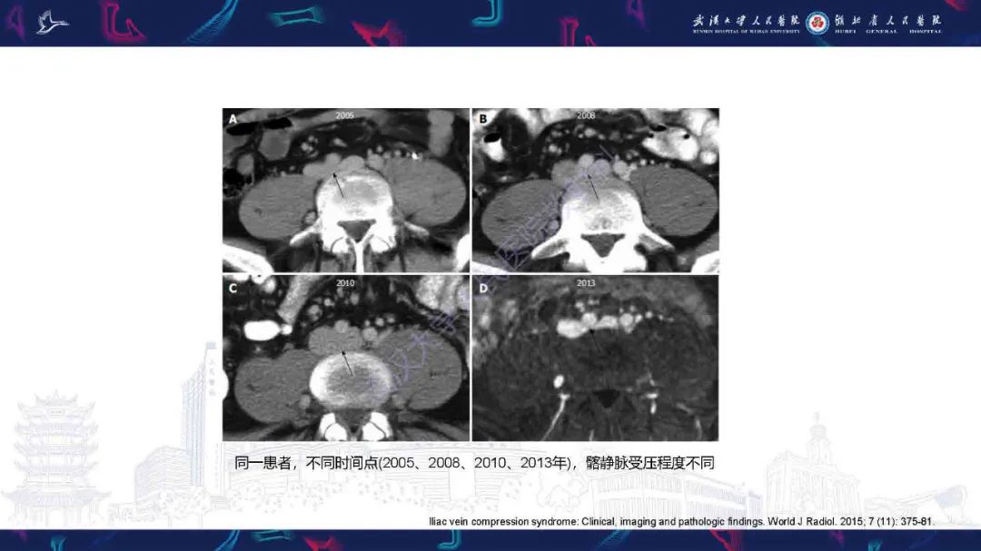 影像PPT - 【PPT】髂静脉压迫综合征影像诊断-29