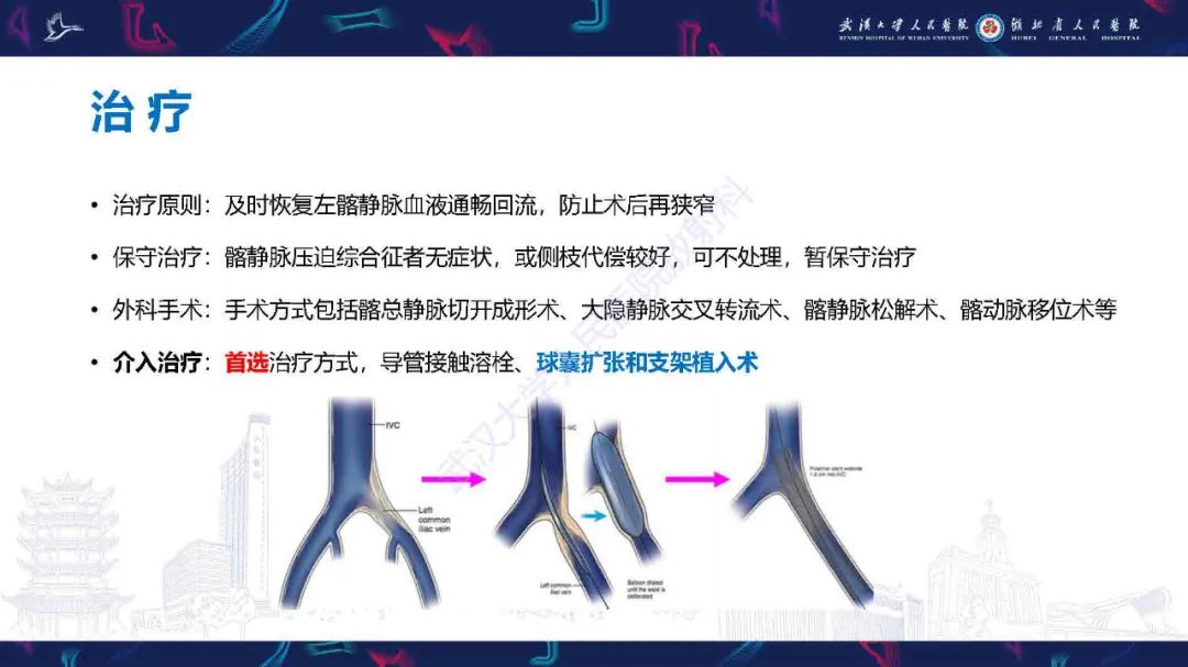 影像PPT - 【PPT】髂静脉压迫综合征影像诊断-31