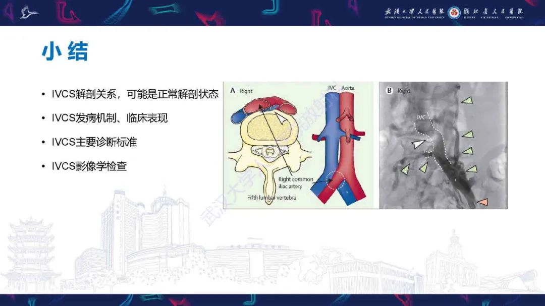 影像PPT - 【PPT】髂静脉压迫综合征影像诊断-33
