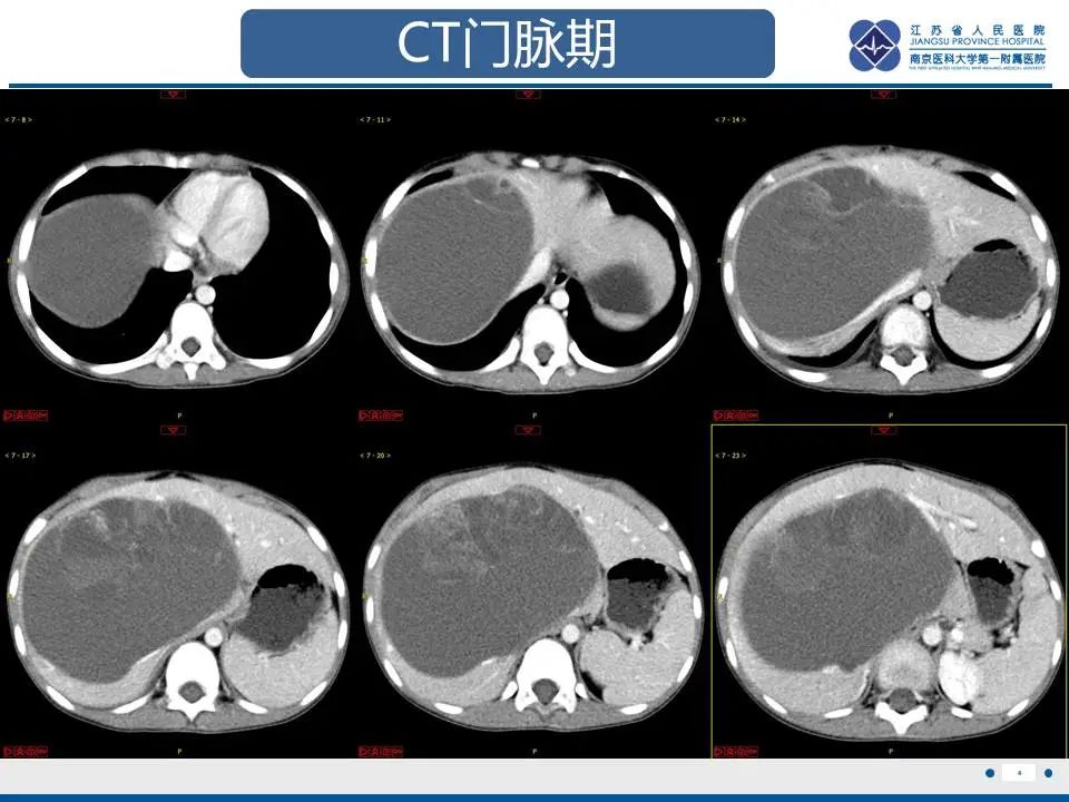影像PPT - 【PPT】肝未分化胚胎肉瘤-5