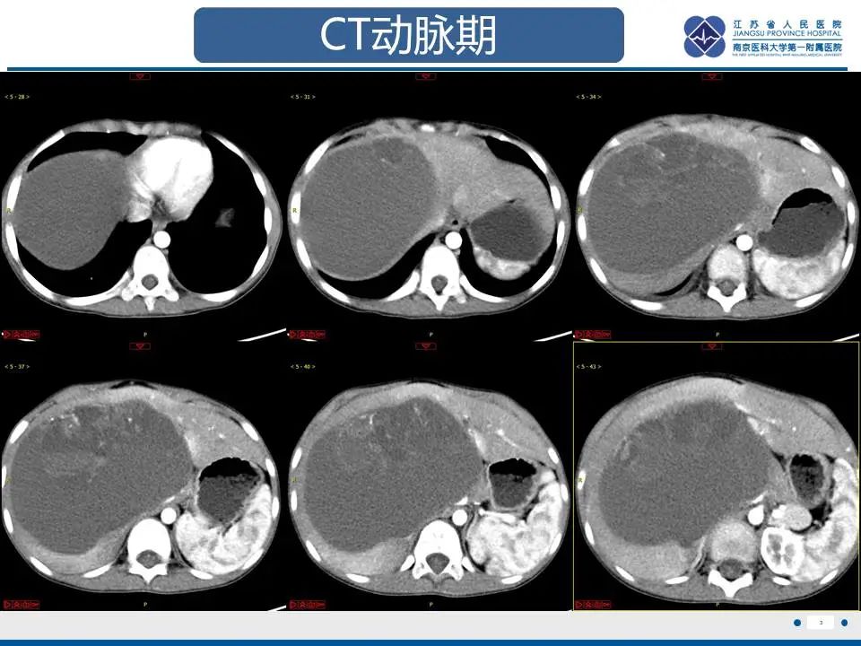 影像PPT - 【PPT】肝未分化胚胎肉瘤-4