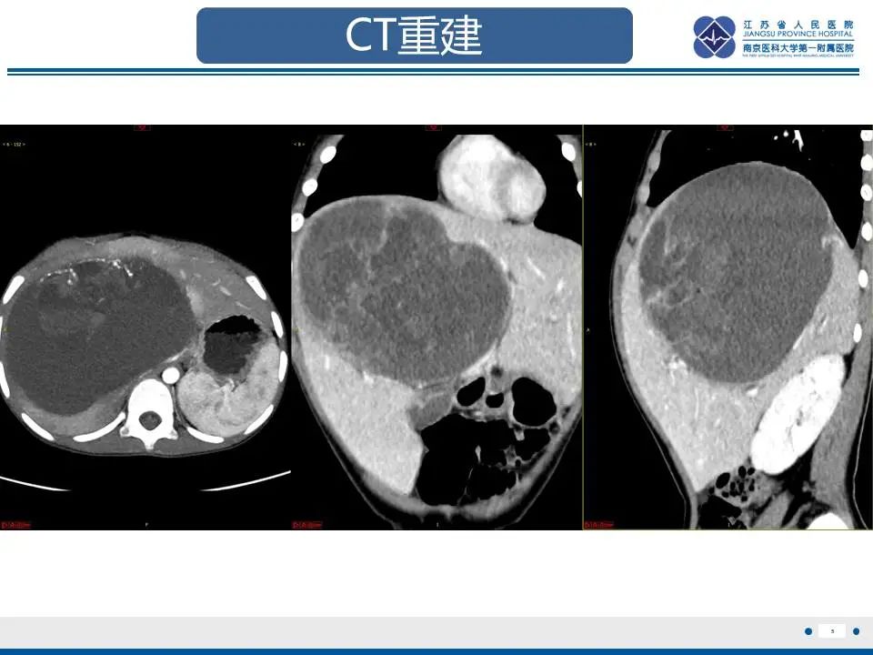 影像PPT - 【PPT】肝未分化胚胎肉瘤-6