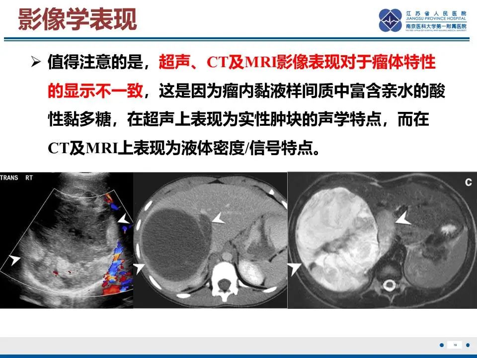 影像PPT - 【PPT】肝未分化胚胎肉瘤-20