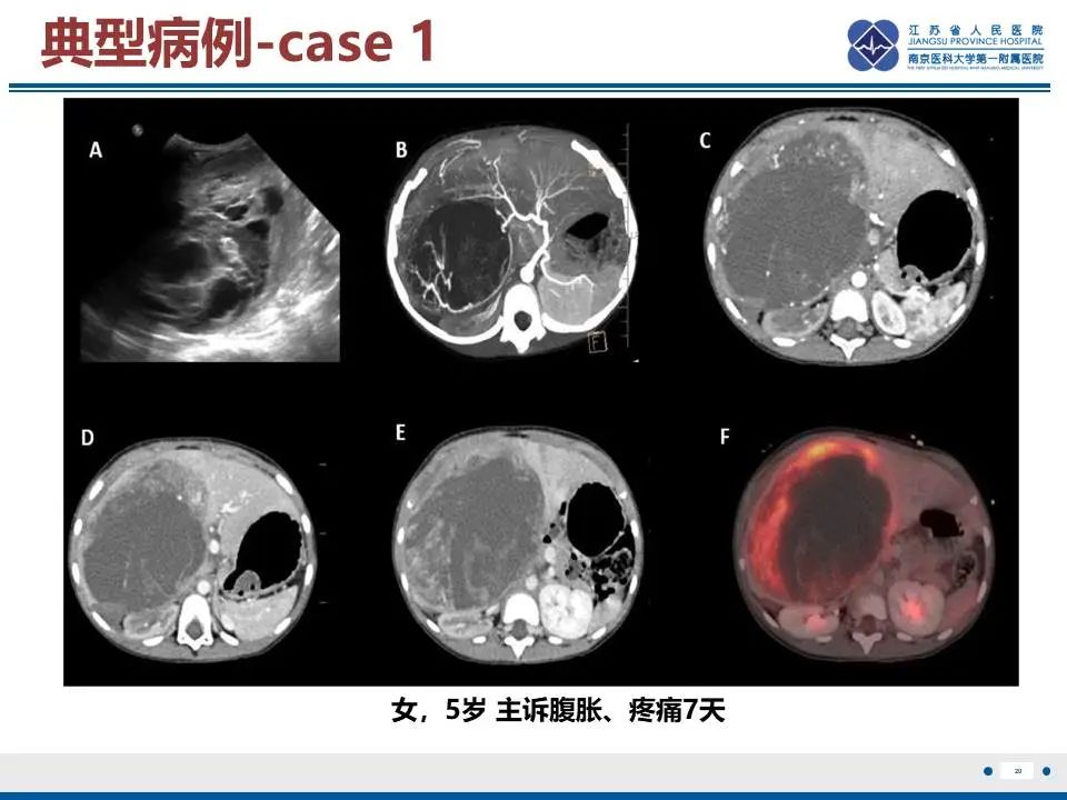 影像PPT - 【PPT】肝未分化胚胎肉瘤-21