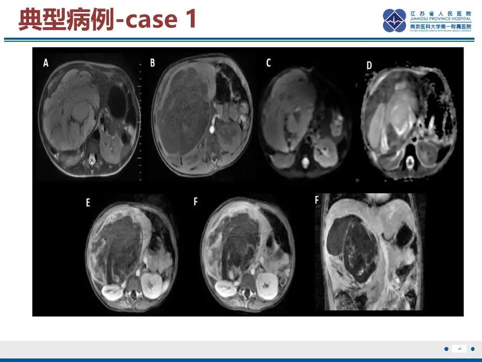影像PPT - 【PPT】肝未分化胚胎肉瘤-22