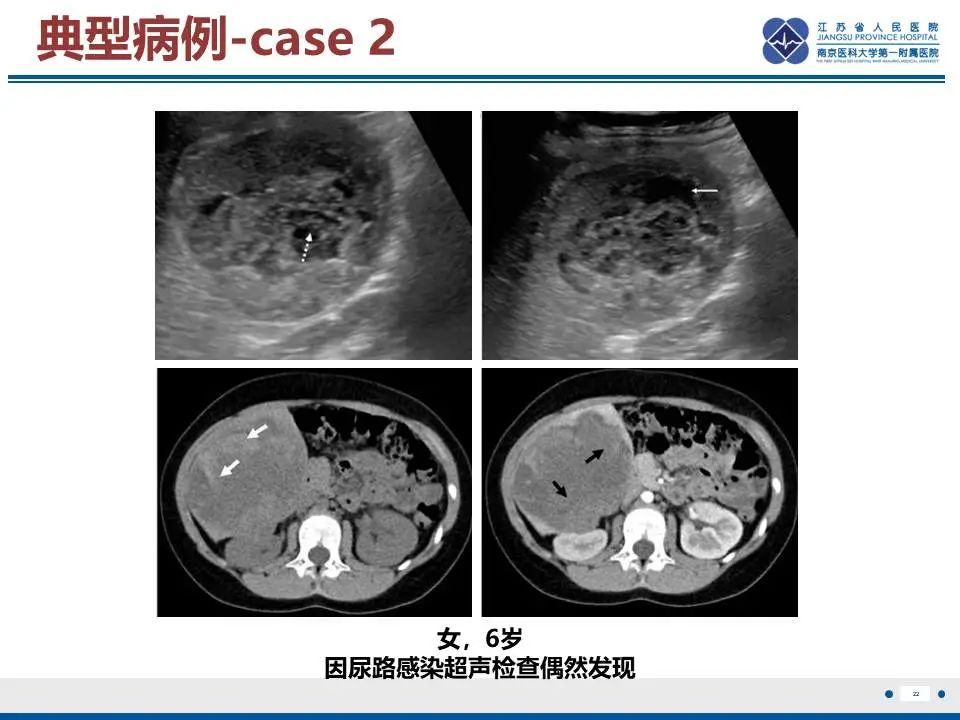 影像PPT - 【PPT】肝未分化胚胎肉瘤-23