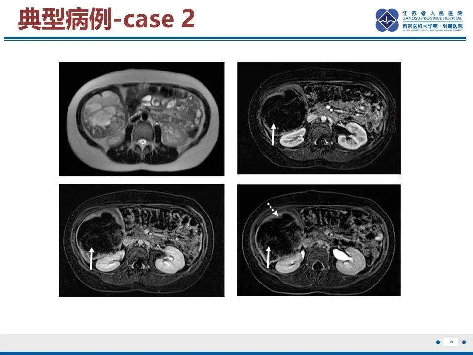 影像PPT - 【PPT】肝未分化胚胎肉瘤-24