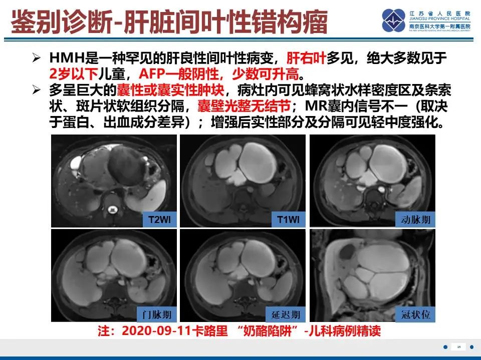影像PPT - 【PPT】肝未分化胚胎肉瘤-26