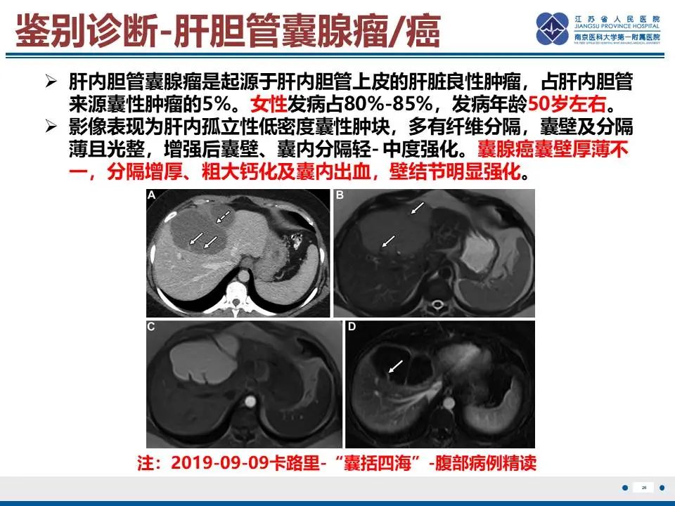影像PPT - 【PPT】肝未分化胚胎肉瘤-27