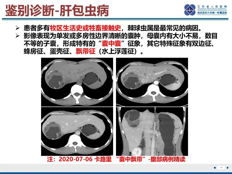 影像PPT - 【PPT】肝未分化胚胎肉瘤-28