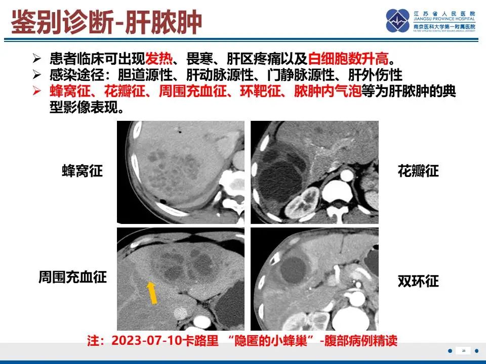 影像PPT - 【PPT】肝未分化胚胎肉瘤-29