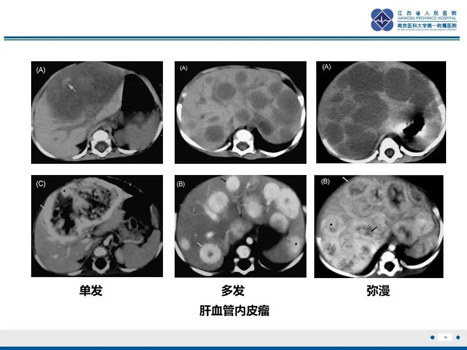 影像PPT - 【PPT】肝未分化胚胎肉瘤-31