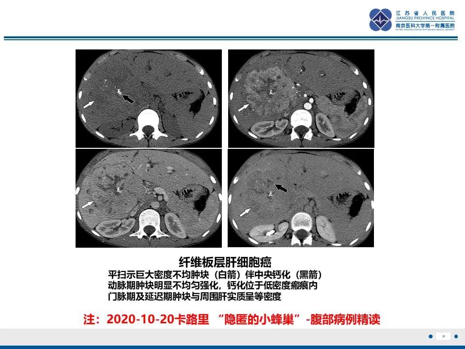 影像PPT - 【PPT】肝未分化胚胎肉瘤-32