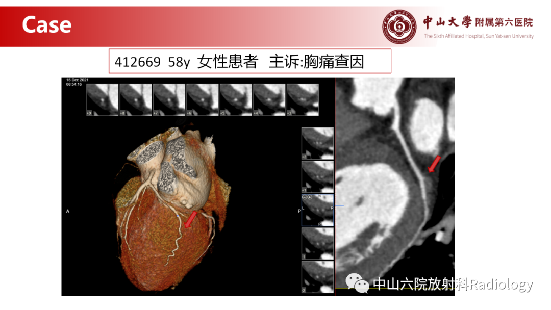 影像PPT - 【PPT】心肌桥的分型及影像诊断-1