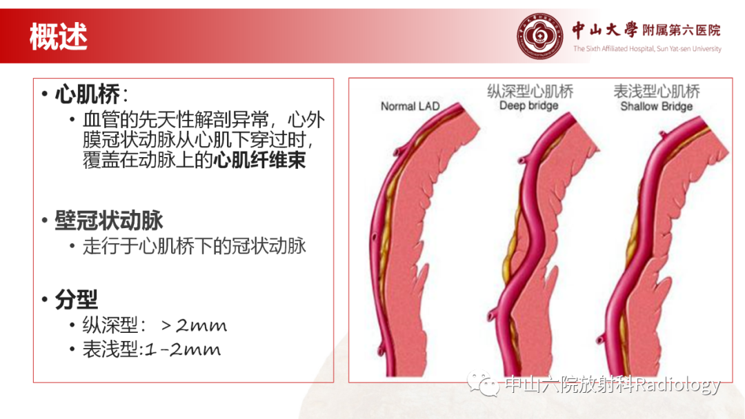 影像PPT - 【PPT】心肌桥的分型及影像诊断-5