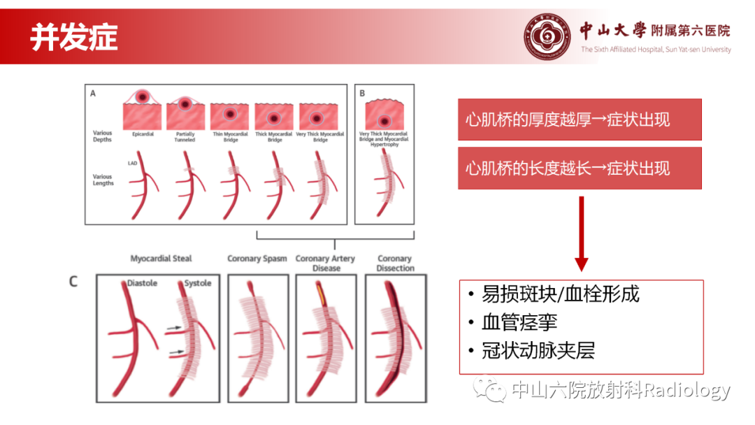 影像PPT - 【PPT】心肌桥的分型及影像诊断-8