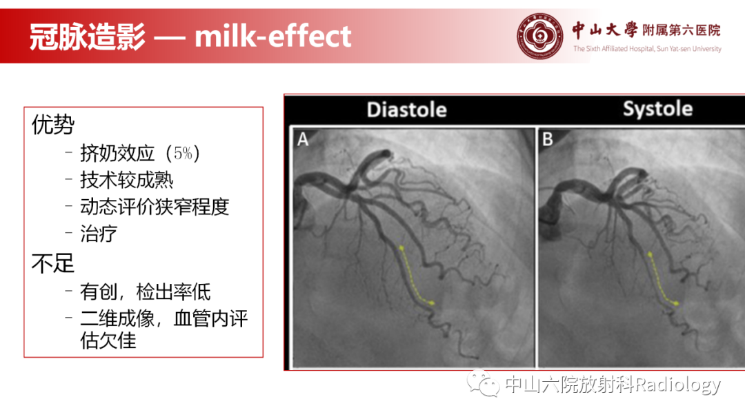 影像PPT - 【PPT】心肌桥的分型及影像诊断-12
