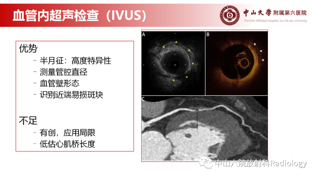 影像PPT - 【PPT】心肌桥的分型及影像诊断-13