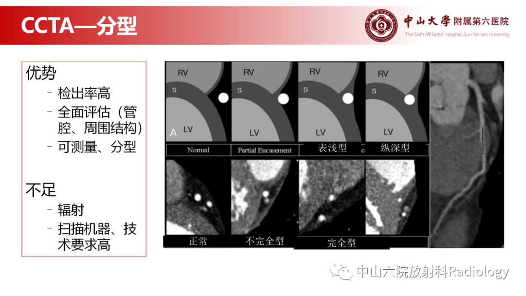 影像PPT - 【PPT】心肌桥的分型及影像诊断-15
