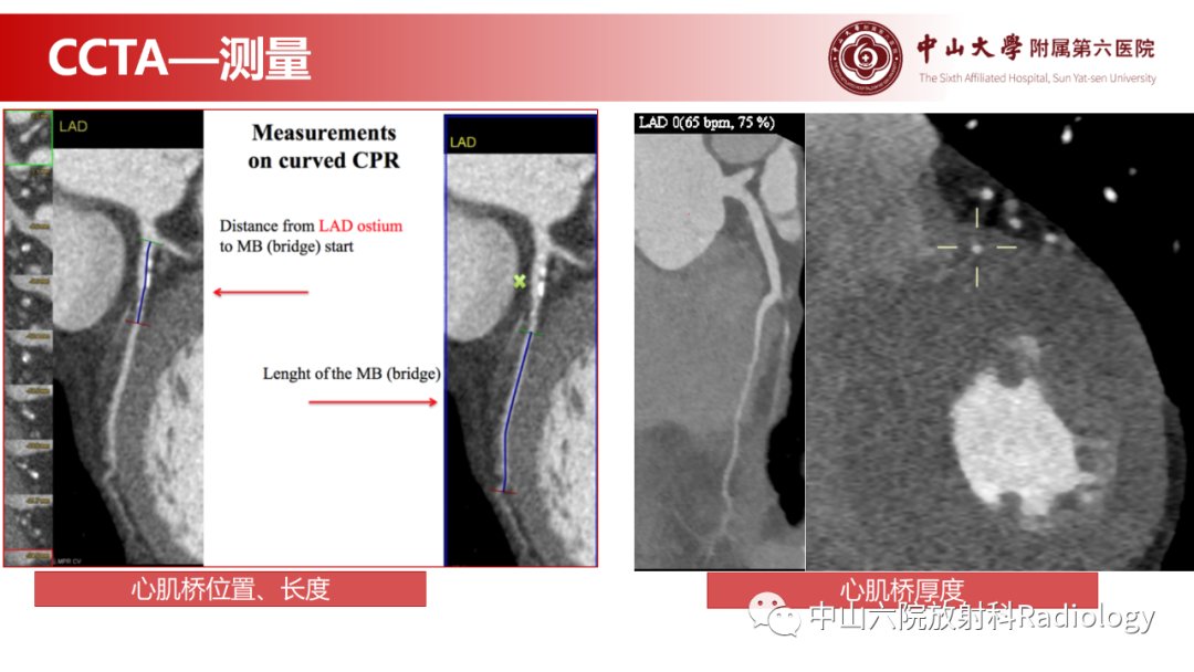 影像PPT - 【PPT】心肌桥的分型及影像诊断-16