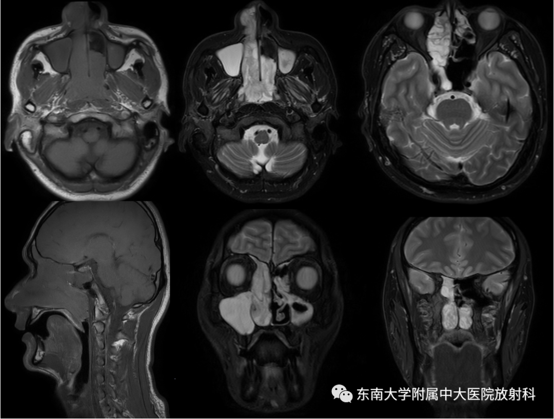 影像PPT - 【PPT】鼻腔鼻窦内翻性乳头状瘤-1
