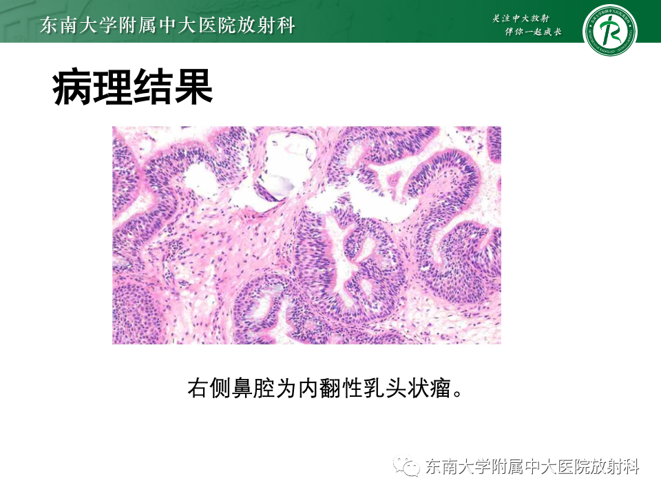 影像PPT - 【PPT】鼻腔鼻窦内翻性乳头状瘤-3