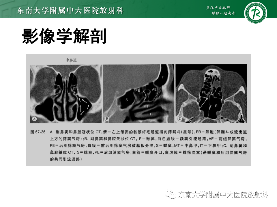 影像PPT - 【PPT】鼻腔鼻窦内翻性乳头状瘤-5