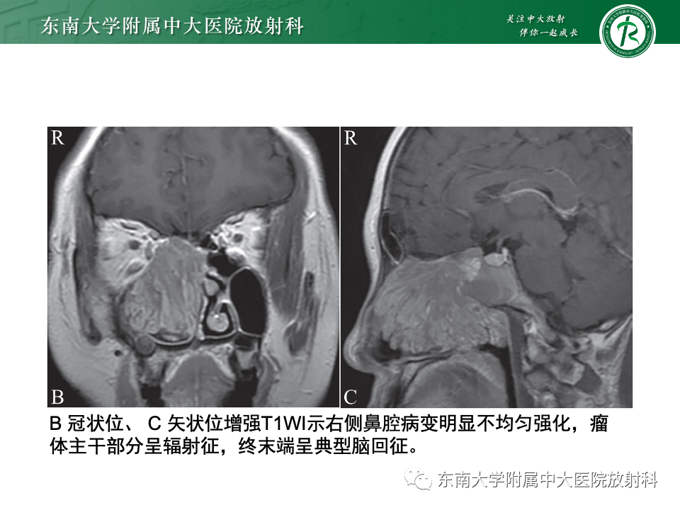 影像PPT - 【PPT】鼻腔鼻窦内翻性乳头状瘤-14