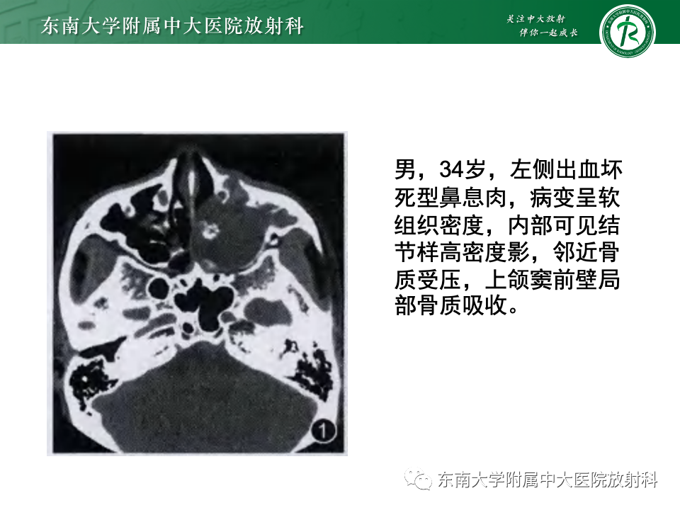 影像PPT - 【PPT】鼻腔鼻窦内翻性乳头状瘤-20