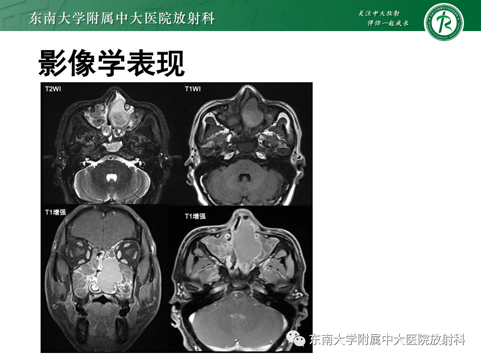影像PPT - 【PPT】鼻腔鼻窦内翻性乳头状瘤-19