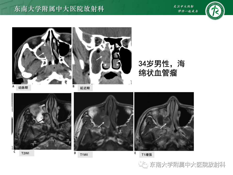 影像PPT - 【PPT】鼻腔鼻窦内翻性乳头状瘤-22