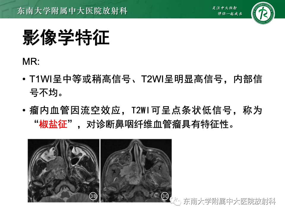 影像PPT - 【PPT】鼻腔鼻窦内翻性乳头状瘤-25