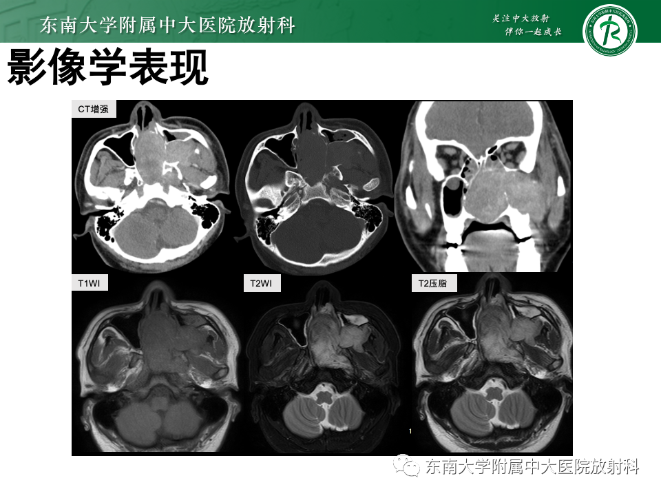 影像PPT - 【PPT】鼻腔鼻窦内翻性乳头状瘤-26
